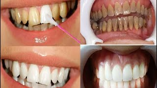 JEITO FÁCIL E BARATO para remover o tártaro e deixar os dentes BRANCOS [upl. by Yesmar303]