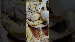 Detaching the loop of large intestine shorts anatomy dissection [upl. by Nestor]