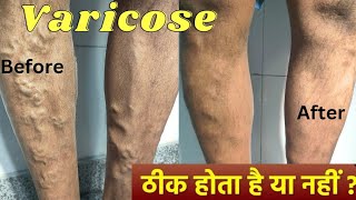 Varicose veins treatment with foam Sclerotherapy and Diode laser Result  varicose veins treatment [upl. by Ethe]