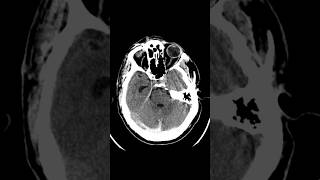 Cerebral venous thrombosis ctbrain [upl. by Ennaeus]