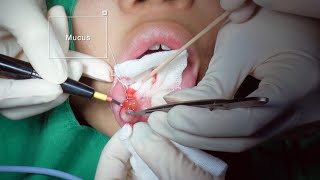 Mucocele removal surgery 입술점액낭종  JUDITH PS KOREA 유디트성형외과 [upl. by Coffeng]