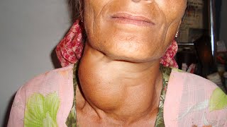 11 Goiter Treatment Without Surgery Causes and Symptoms [upl. by Myra]