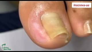 Unhas encravadas 022024 viral ingrowntoenail infectednail podologoleonardovieira [upl. by Eelsha]