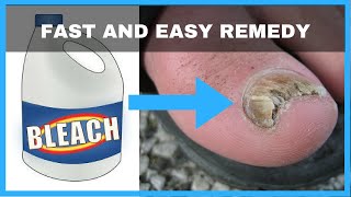 How to Get Rid of Toenail Fungus with Bleach  Toe Fungus Journey [upl. by Aloeda]