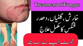 Fungal Skin Infection Treatment By Hakeem Sarfraz Multani 03036491983 [upl. by Suoirtemed20]