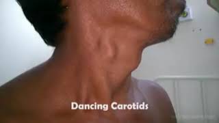 Dancing carotid aortic regurgitation 👇 read description [upl. by Vish869]