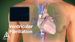 Défibrillation dune fibrillation ventriculaire [upl. by Ahsikyt]