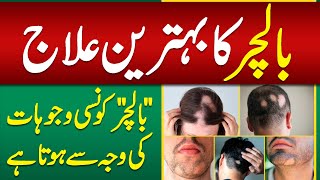 Patchy Hair Loss  Balchar Ka ilaj  Types of Alopecia Signs Causes and Treatment  Balo Ka Girna [upl. by Etam]