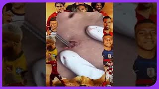 Satisfying Blackhead Removal Popping Pimples and Blackheads on Skin  2024 [upl. by Brynna5]