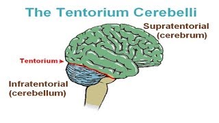 Classification of Brain Herniation [upl. by Chlo676]