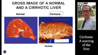 CIRRHOSIS LIVER SCARRING by Dr Robert Gish [upl. by Veriee452]