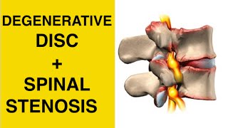 Sciatica Exercises  Stretches for Spinal Stenosis amp Degenerative Disc Disease Treatment [upl. by Wane]