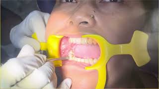 Mandibular Right First Molar Extraction dentistrydentist trending youtube oralsurgery [upl. by Mccomb908]