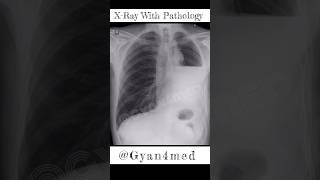 Chest XRay Normal vs Abnormal view [upl. by Pape]