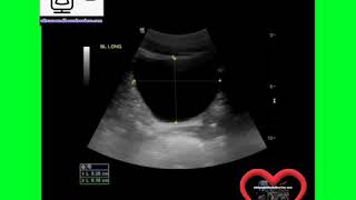 Ultrasound Board Review on Bladder Ultrasound [upl. by Blinny]