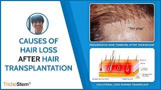 Possible Causes of Hair Loss after Hair Transplant [upl. by Mure]