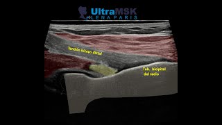 ¿Como evaluar la porción distal del bíceps en ultrasonido [upl. by Leonora]