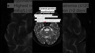 Central pontine myelinolysis [upl. by Madison877]