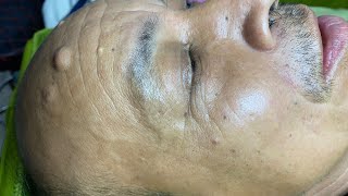 Acne treatment for Spa Linh Mun 2023 012 [upl. by Artened]