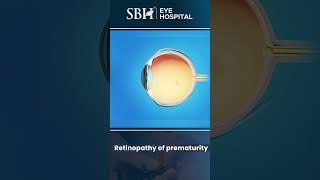 What is retinopathy of prematurity  Retinopathy of prematurity  Eye Treatment  SBH Hospital [upl. by Lazar]