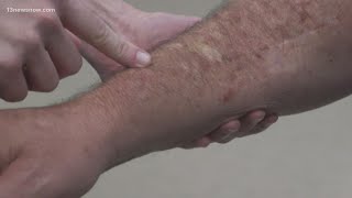 Skin Cancer How to spot melanoma warning signs [upl. by Judy500]