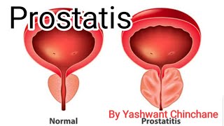 Prostatis Types of prostatis Causes of prostatisGross appearanceHistological appearance [upl. by Nnaeirb]