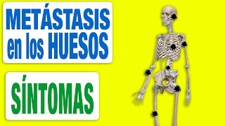 Todos los Síntomas de las Metástasis en los Huesos [upl. by Yhtrod]