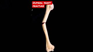 Humeral shaft fracture shorts [upl. by Atterol]