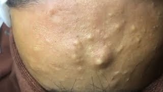 🔍 Pimple Popping Masterclass Safe Acne Removal amp Scar Prevention  2024 Update  TheCoolFactShow [upl. by Assiluj]