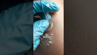 Wart Removal Using Liquid Nitrogen 🥶 warts viralvideo [upl. by Godspeed]