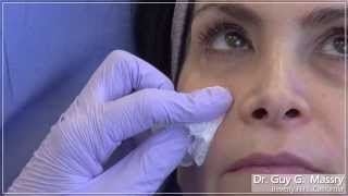 Hyaluronic Acid Gel Filling of the Lower Eyelid and Associated Hollows  Dr Massry [upl. by Franchot700]