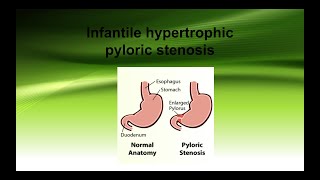 Infantile hypertrophic pyloric stenosis [upl. by Finstad]