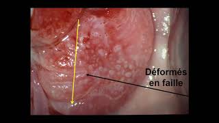 J MARCHETTA  Panorama des aspects colposcopiques  du col normal au cancer [upl. by Suter840]