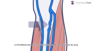 la thrombose veineuse profonde [upl. by Lubet]