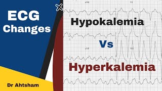 ECG findings Hypokalemia vs Hyperkalemia  Dr Ahtsham [upl. by Alger688]