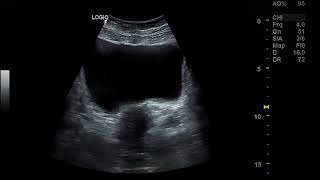 Bicornuate uterus pregnancy [upl. by Anitsuga]