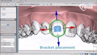 Cementado indirecto de Brackets  3 Formas con Maestro3D Dental Studio  Ortho Studio [upl. by Llemert]