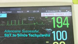 SVT or Supraventricular Tachycardia [upl. by Cullin416]