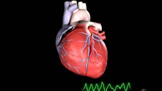 What is Ventricular Fibrillation [upl. by Cuttler]