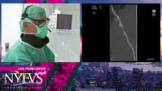 LIVE CASE PRESENTATION 2 CALCIFIED COMBINED ILIAC AND CFA ILIOFEMORAL DISEASE INTERVENTION Broa [upl. by Indira]