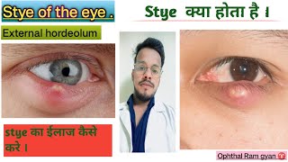 whats are stye  cause  signs and symptoms and Treatment [upl. by Cyna]