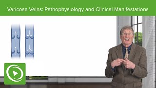 Varicose Veins Pathophysiology and Clinical Manifestations [upl. by Yenahc]