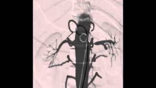 ANGIO Mentor  ANGIO Diagnostic Arteriogram [upl. by Aelrac]