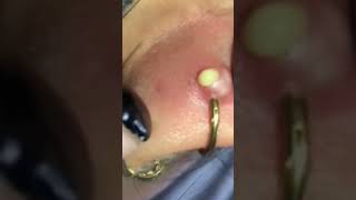 Extraction Satisfaisante 😌👌acne blackheads asmr [upl. by Acinet560]