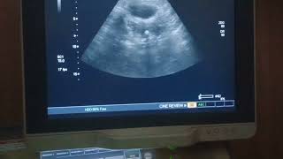 Osseous metaplasia uterus pelvicultrasound pathology [upl. by Llenroc]