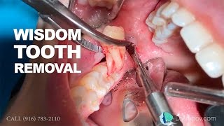 Wisdom tooth removal in 5 MIN or less Surgical Guide Online Course  Free eBook [upl. by Tesil]