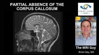 Partial absence of the corpus callosum [upl. by Kappenne]