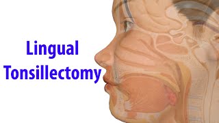 Lingual Tonsillectomy [upl. by Clayberg464]