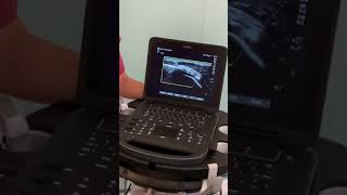 UltrasoundGuided Barbotage for Calcific Tendonitis  Kent MSK Clinic [upl. by Antipus]