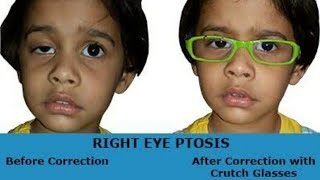 ocular myasthenia gravis treatment in hindi [upl. by Morris]